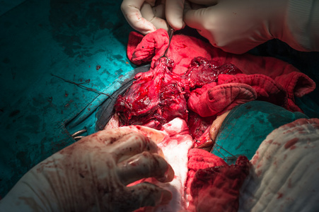 甲状腺手术图片