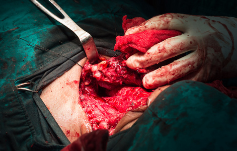 甲状炎甲状腺全切除术照片