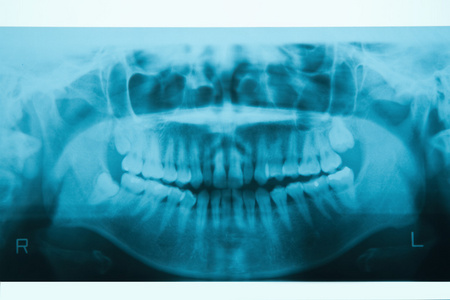 全景牙科 x 线为口腔正畸学和下巴整形的