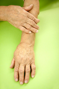 类风湿关节炎从变形的女人的手