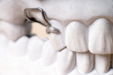 假牙清洗假牙照片