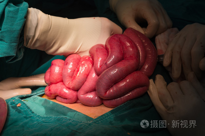 开腹阑尾切除术破裂的阑尾炎女人心脏造影扫描结扎附录阑尾切除术医学