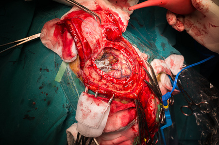 脑动脉瘤开颅手术图片