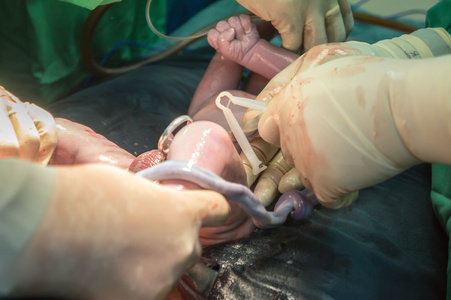 剖腹产过程图片