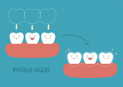 如何由齿概念插画的隐形牙套的