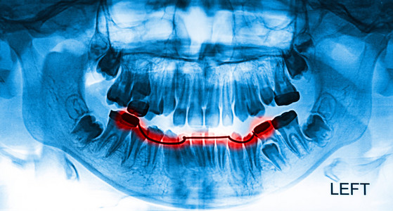 人类牙齿的 x 线扫描