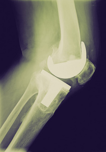 复古的外观 bicompartmental 膝关节假体 x 射线