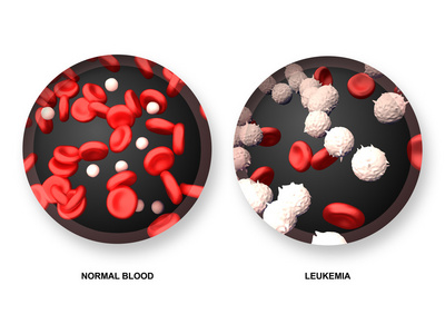 白血病 vs 正常的血液