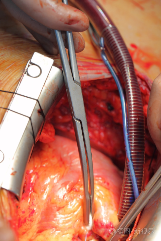 对心脏和血管的手术特写照片