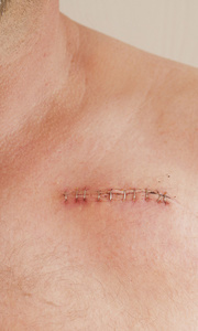 心脏起搏器的伤疤照片