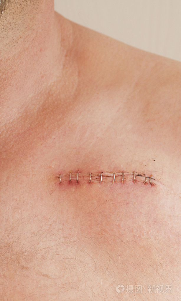 心脏起搏器的伤疤