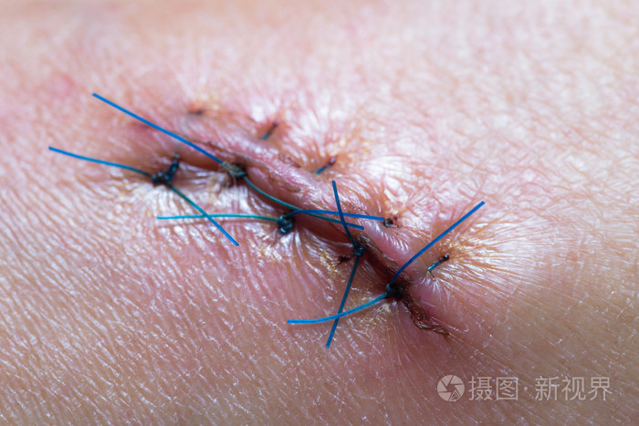 缝合的伤口