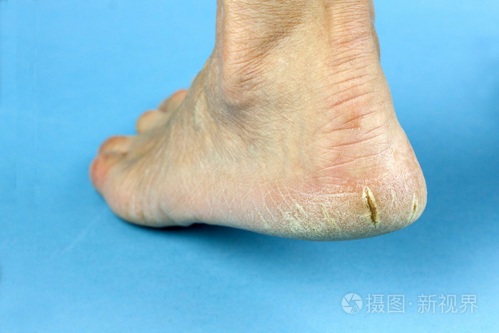 在蓝色背景上的裂纹的脚跟