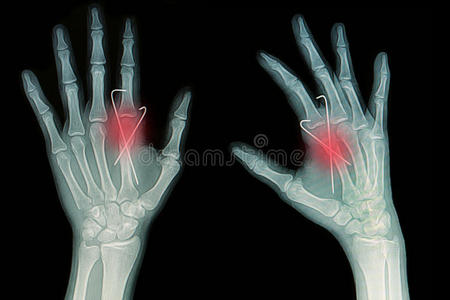 手部骨折的x线平片