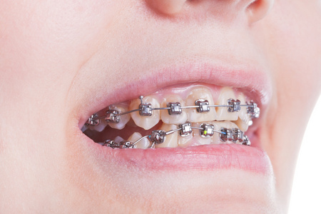 orthodontology牙齿上的正畸牙套关闭照片