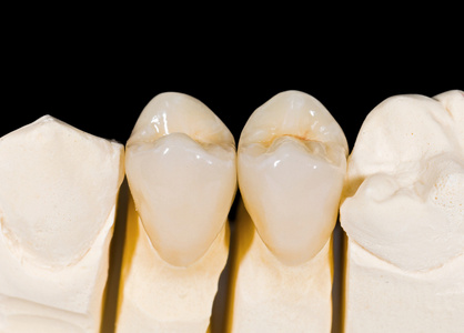 牙科修复产品图片