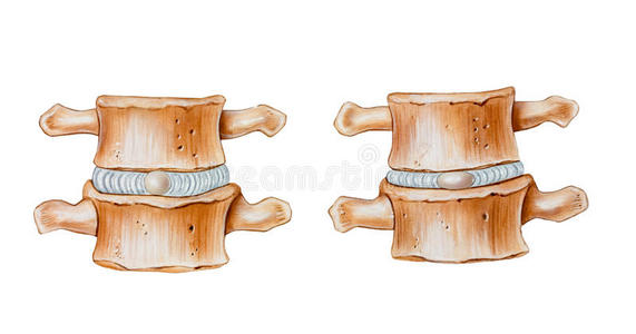 椎间盘的脊柱缓冲功能