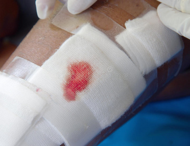处理伤口纱布伤口.照片