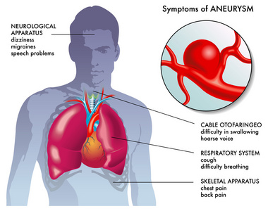 动脉瘤症状