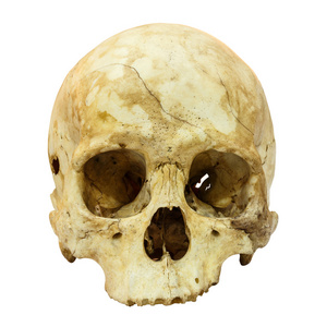 颅骨骨折人类颅骨骨折 蒙古人种,亚洲 孤立背景照片