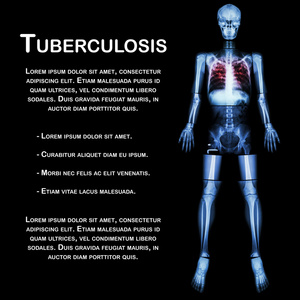肺结核TBX线全身头颅骨颈SP