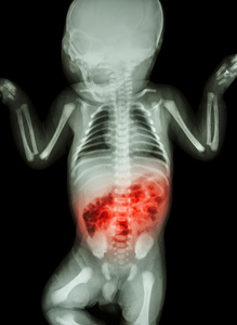 肠炎患病婴儿x线和肠道炎症