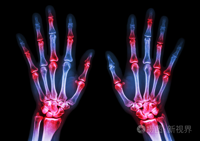 人体双手及关节炎多关节(围棋)