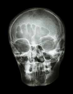 X 射线泰国人的 skulloblique