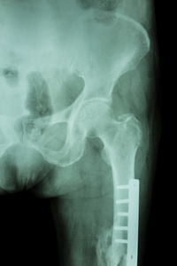 薄膜 x 射线骨折 femurThigh bone。它经营和除