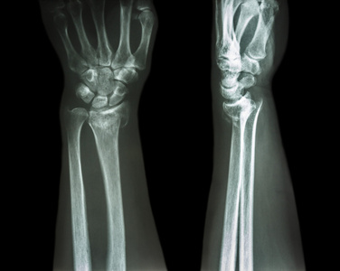 屈曲型桡骨远端骨折图片