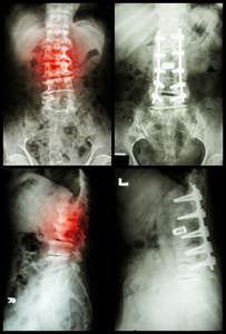 脊椎病和滑脱症，手术和手术间