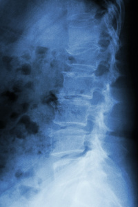 薄膜 x 射线腰椎侧 显示腰椎爆裂性骨折