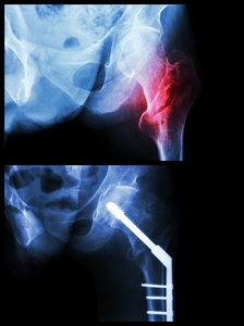 股骨粗隆间骨折左的股骨 大腿骨折骨。它经营和插入带锁髓内钉