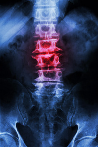 老年脊柱腰骶骨病症片