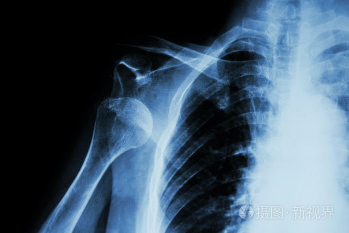 肩关节前脱位的x线