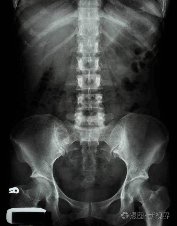 X 射线腰骶脊柱和骨盆的人