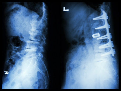 脊椎病左图病人的手术内f