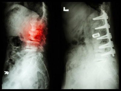 脊椎病左图病人的手术内f