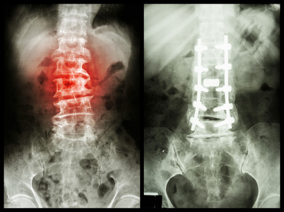 脊椎病左图病人手术及内f