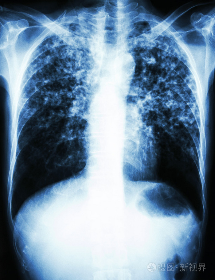肺结核片子图片特点图片