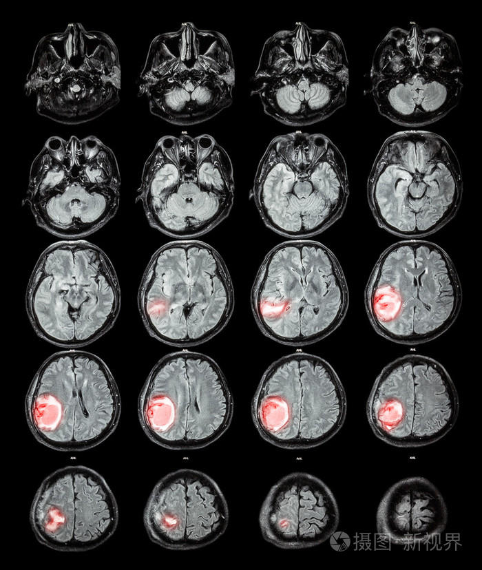 磁共振脑在右顶叶脑肿瘤