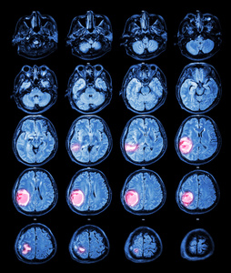 磁共振脑 在右顶叶脑肿瘤