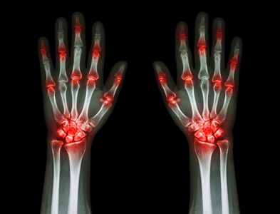 类风湿关节炎手图片