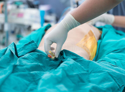 保留导尿管照片