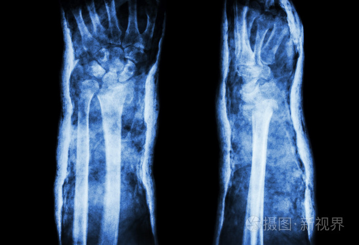 桡骨远端骨折(colles骨折)和铸型(前)