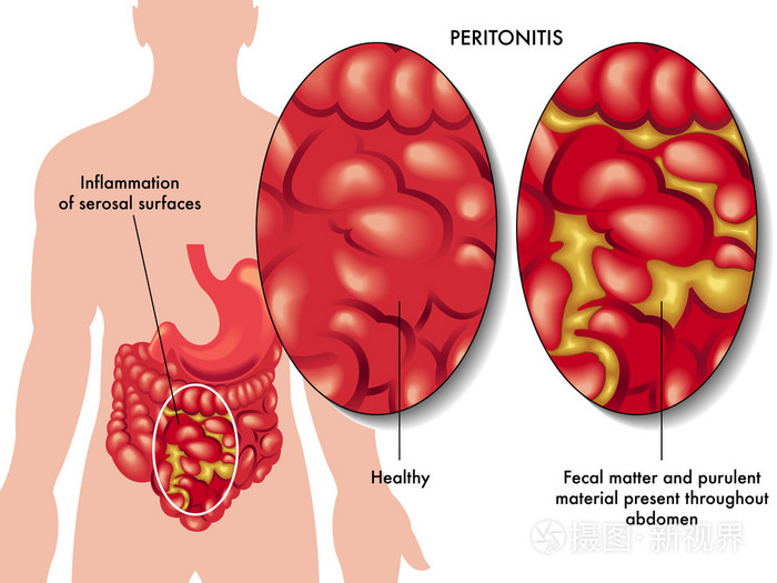 人体腹膜炎图片图片