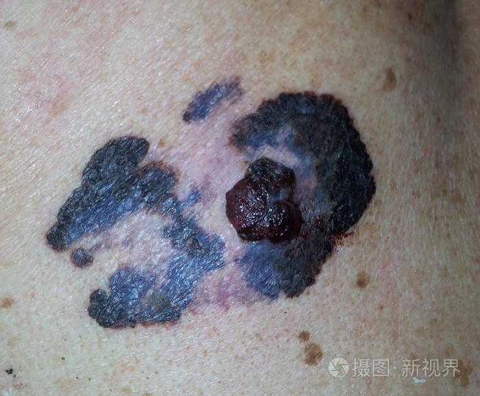 血管瘤黑痣癌变_脚底黑痣癌变_黑痣癌变图片