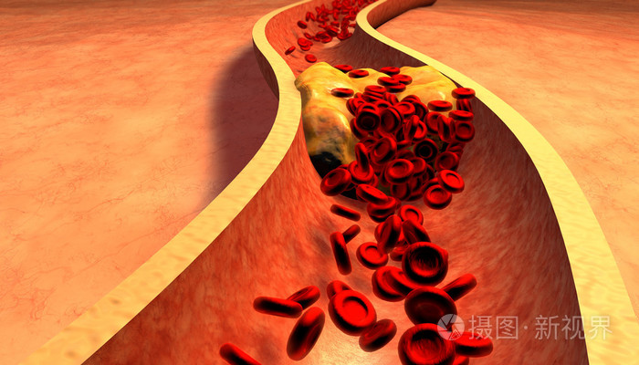 血小板与胆固醇斑块阻塞的动脉