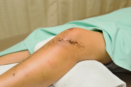 手术的膝盖和腿部后缝合的伤口照片