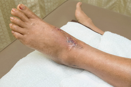 踝关节伤口缝合照片